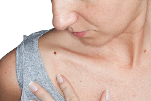 How To Get Rid of Moles on Skin: Is It Safe?
