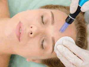 Read more about the article What Does Microneedling Do For Your Skin?