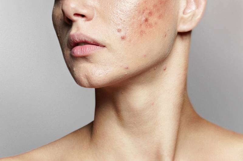 The Best Acne Skincare Routine