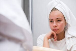 What are acne scars and what causes them? 