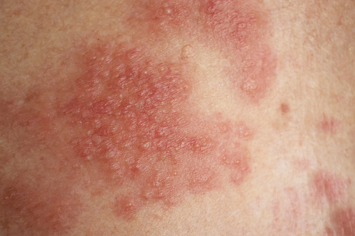 Eczema disease on the skin close up