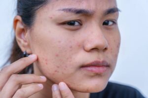 Acne marks vs acne scars: How to tell the difference