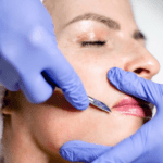 Dermaplaning