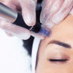 microneedling