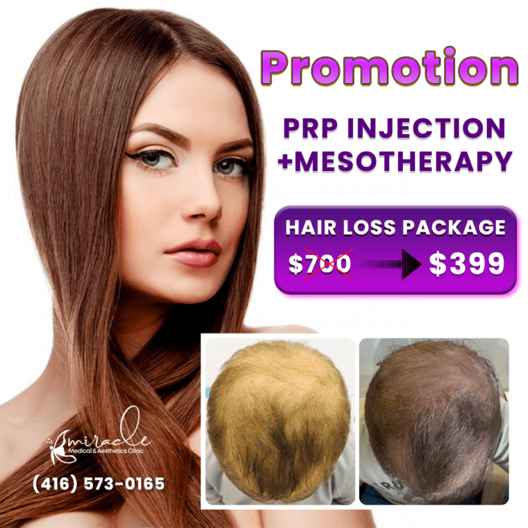 PRP injection + Mesotherapy